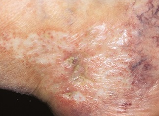 Warnvenen im Knöchelbereich