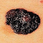 Beispiel eines sehr großen Hauttumors