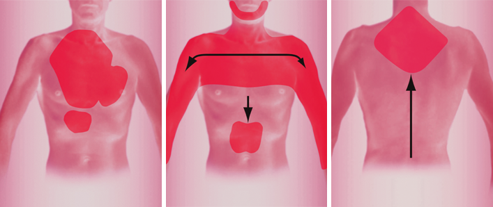 Schmerzabbildung: Alarmzeichen für einen Herzinfarkt