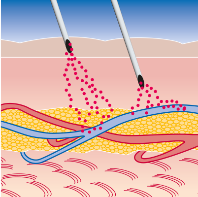 Darstellung Wirkung im Körper durch subkutane Medikamentenzufuhr