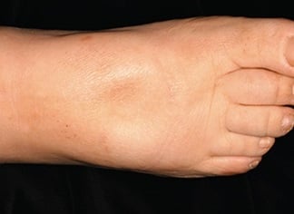 Test auf beginnende Veneninsuffizienz