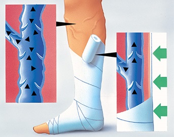 Darstellung der Wirkungsweise einer Kompressionstherapie