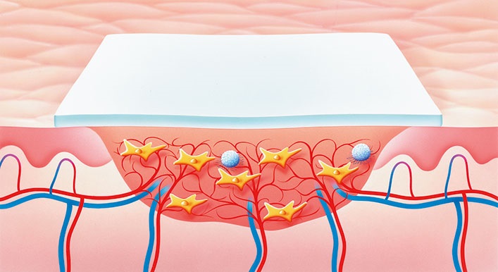 Rolle des Wundverbandes in der Granulationsphase