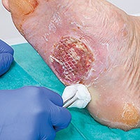 Wundsäuberung mit Einmalpinzette