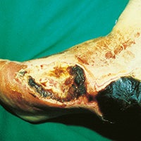 Abbildung eines absterbenden Fußes