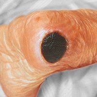 Abbildung eines Dekubitus am Fuß