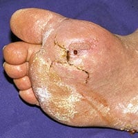 Abbildung eines offenen Fußes