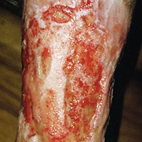 Abbildung eines wunden Schienbeins