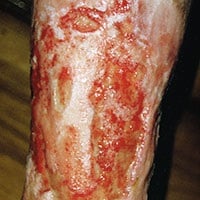 Abbildung eines wunden Schienbeins