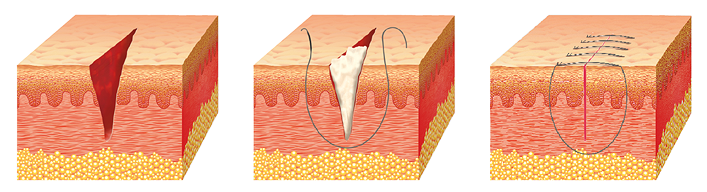 Verzögerte Primärheilung bei Infektionsgefahr