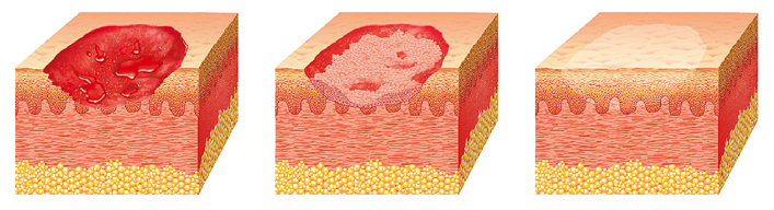 Regenerative Heilung bei oberflächlichen Verletzungen