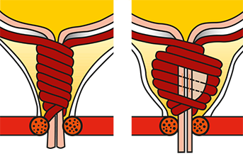 Darstellung des Verschlusssystems einer Blase