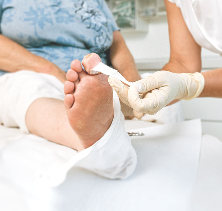 Verbandwechsel Kompresse auflegen