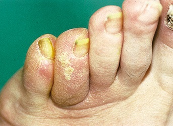 Angiopathischer Fuß