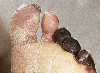 Angiopathischer Fuß