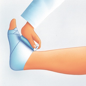 Schritt-für-Schritt Anleitung zum Anlegen eines Kompressionsverbandes