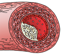 Darstellung einer Arterie mit beginnender Arteriosklerose