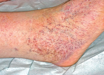 Warnvenen im Knöchelbereich