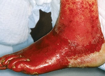 Kontaktekzeme bei Ulkus-Patient