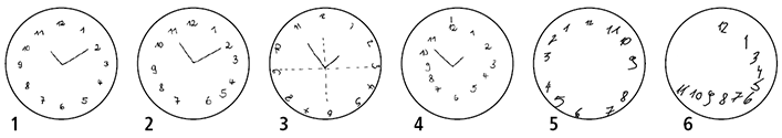 Uhrenzeichentest bei Demenz