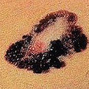 Beispiel eines unterschiedlich gefärbten Tumors auf der Haut