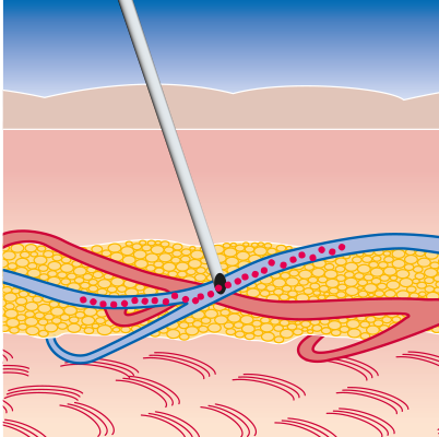 Darstellung der Nadeln in der Haut bei intravenöser Medikamentenverabreichung