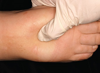 Test auf beginnende Veneninsuffizienz