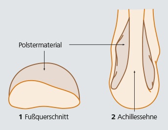 Darstellung von Auf- und Abpolstern in der Kompressionstherapie