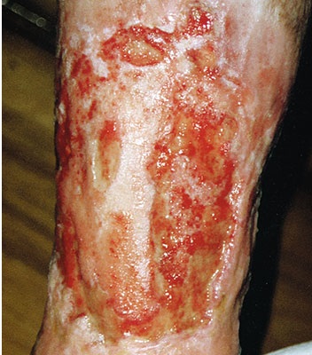 Offenes Geschwür am Schienbein