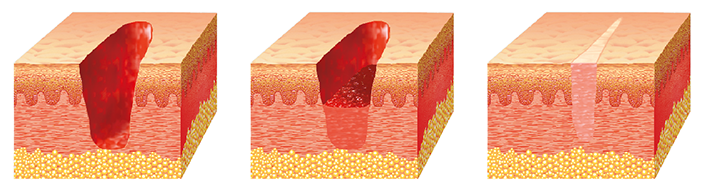 Sekundäre Wundheilung bei komplizierteren Verletzungen