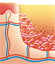 Darstellung der Blutstillung der Wunde in der Reinigungsphase