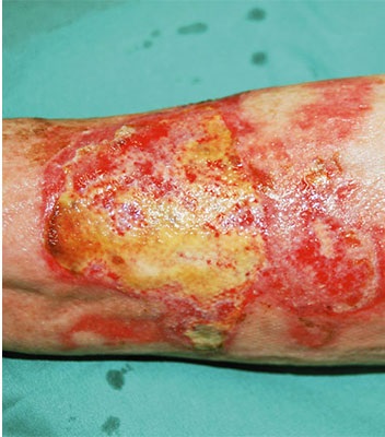 Wunde durch thermische oder chemische Verbrennung