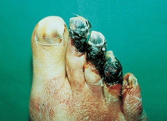 Absterbende Zehen in Folge eines Gefäßverschlusses