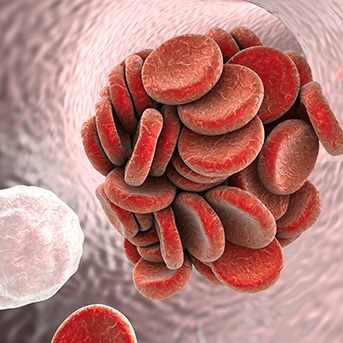 Thrombosegefahr durch Blutgerinnsel