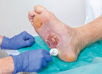 Verbandwechsel Wundreinigung mit Wattetupfer