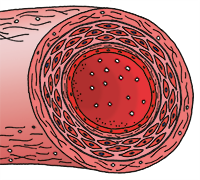 Darstellung einer Arterie mit beginnender Arteriosklerose