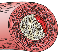 Darstellung einer Arterie mit beginnender Arteriosklerose