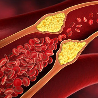 Darstellung Arteriosklerose