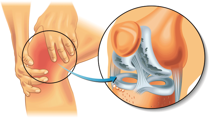 Darstellung von Arthritis im Knie