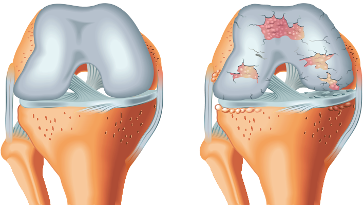 Darstellung einer Arthrose im Knie