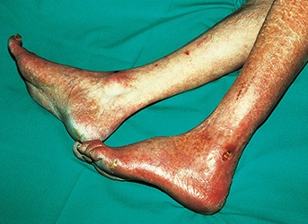 Füße mit starken Durchblutungsstörungen