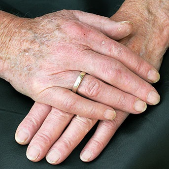 Hände mit veränderten Hautanhangsgebilden übereinander gelegt