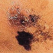 Beispiel einer verwaschenen, unbegrenzten Hautveränderung als Zeichen für einen Tumor auf der Haut