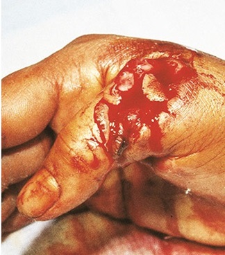 Blutende Hand mit mechanischer Wunde